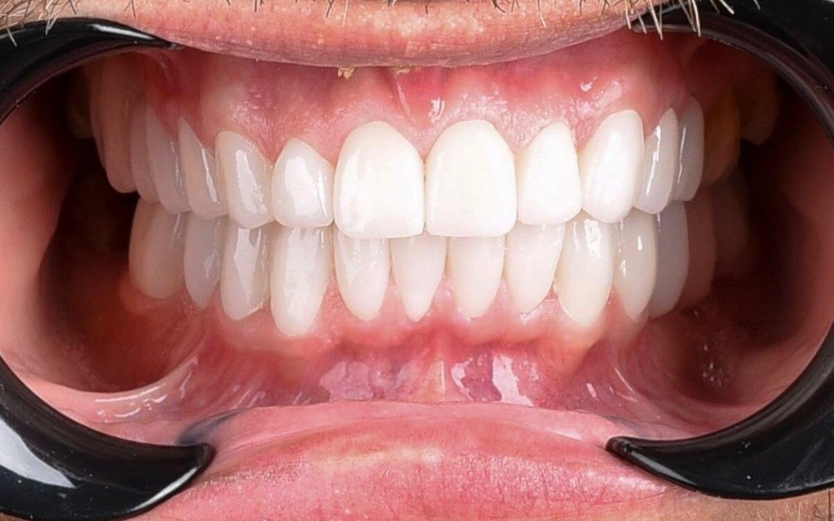 After treatment: upper and lower arches restored with ceramic, even incisal line and a uniform shade