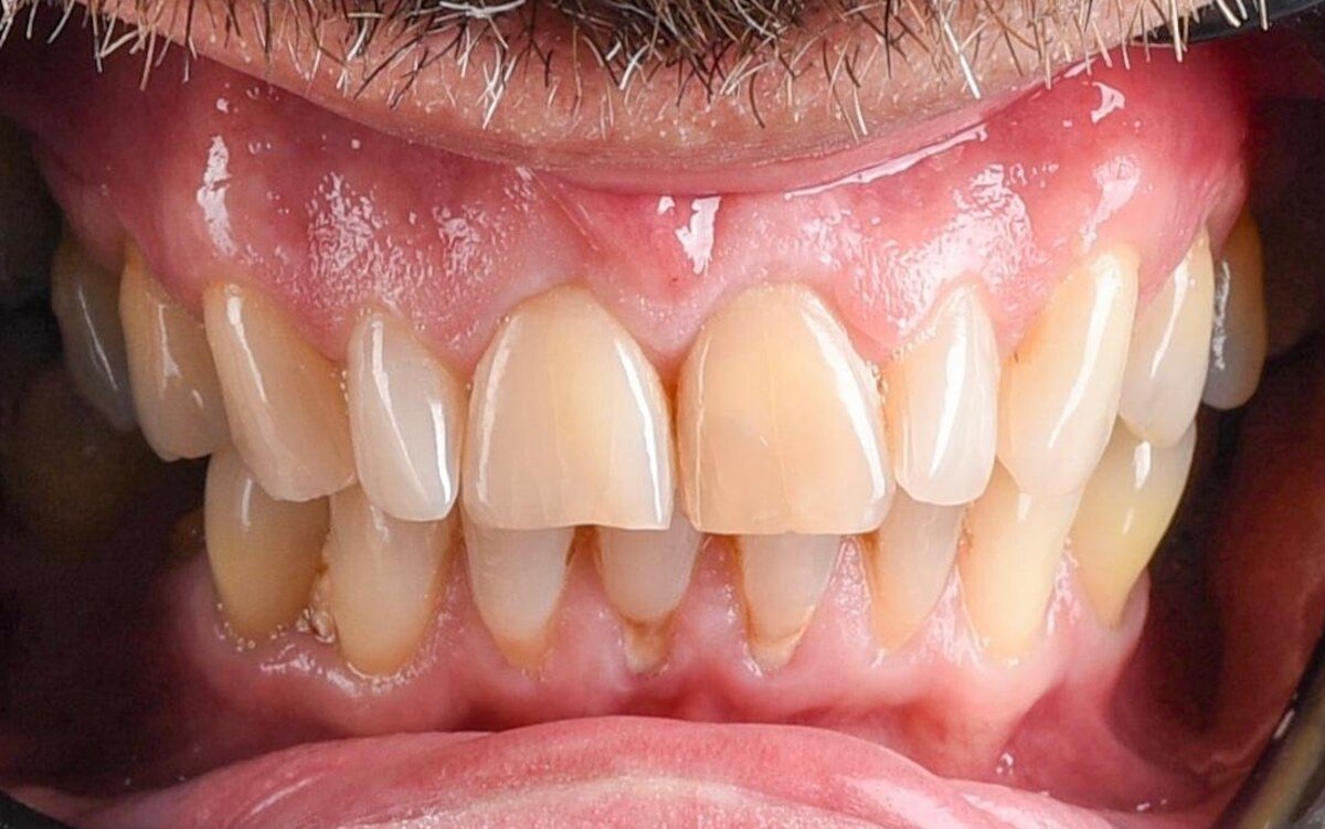Before treatment: worn, unevenly discoloured upper front teeth with inflamed gum margins and crowded, worn lower front teeth