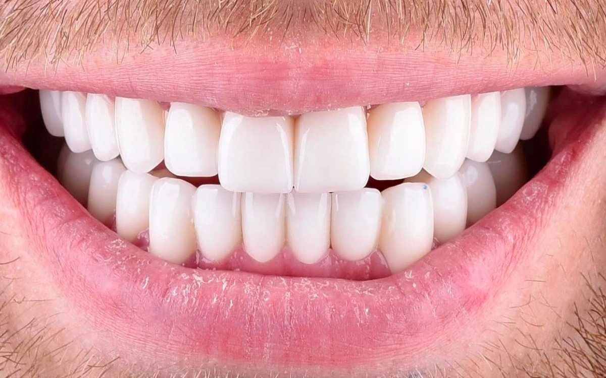After treatment: upper and lower front teeth in one uniform shade with an even incisal line, photographed in a natural smile