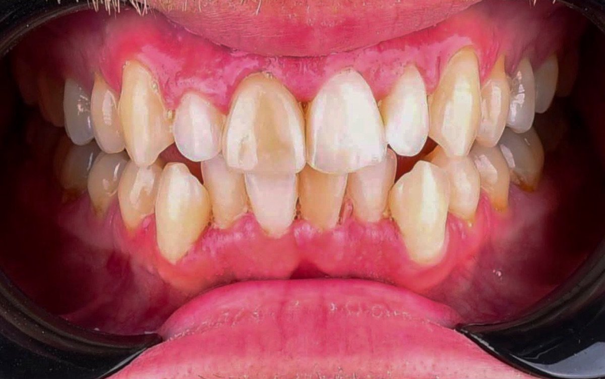 Before treatment: upper front teeth of mismatched shade with rotated lateral incisors, an uneven incisal edge line and reddened, swollen gum margins, and crowded lower front teeth