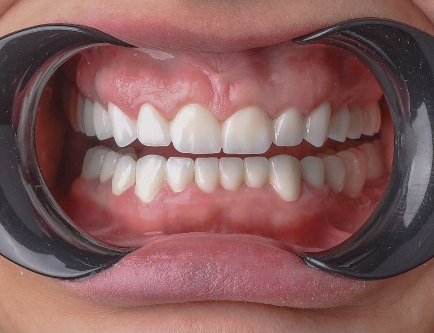 After treatment: upper and lower arches in one uniform shade with an even edge line and gum margins settled against the restorations