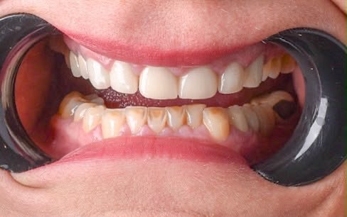 Before treatment: lower front teeth heavily discoloured brown along the gum line with worn, irregular edges, against paler upper front teeth