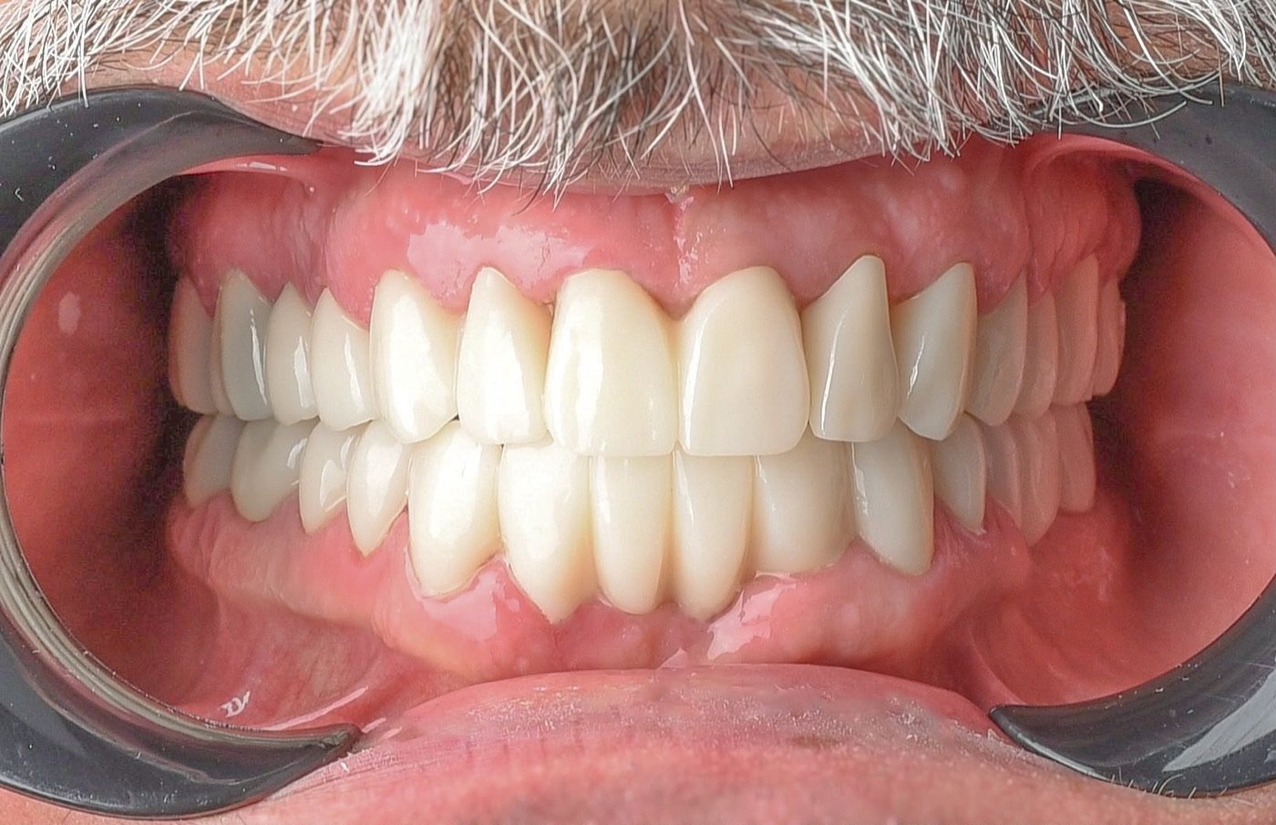 After treatment: upper and lower arches in one uniform shade with an even edge line and gum margins sitting cleanly against the restorations