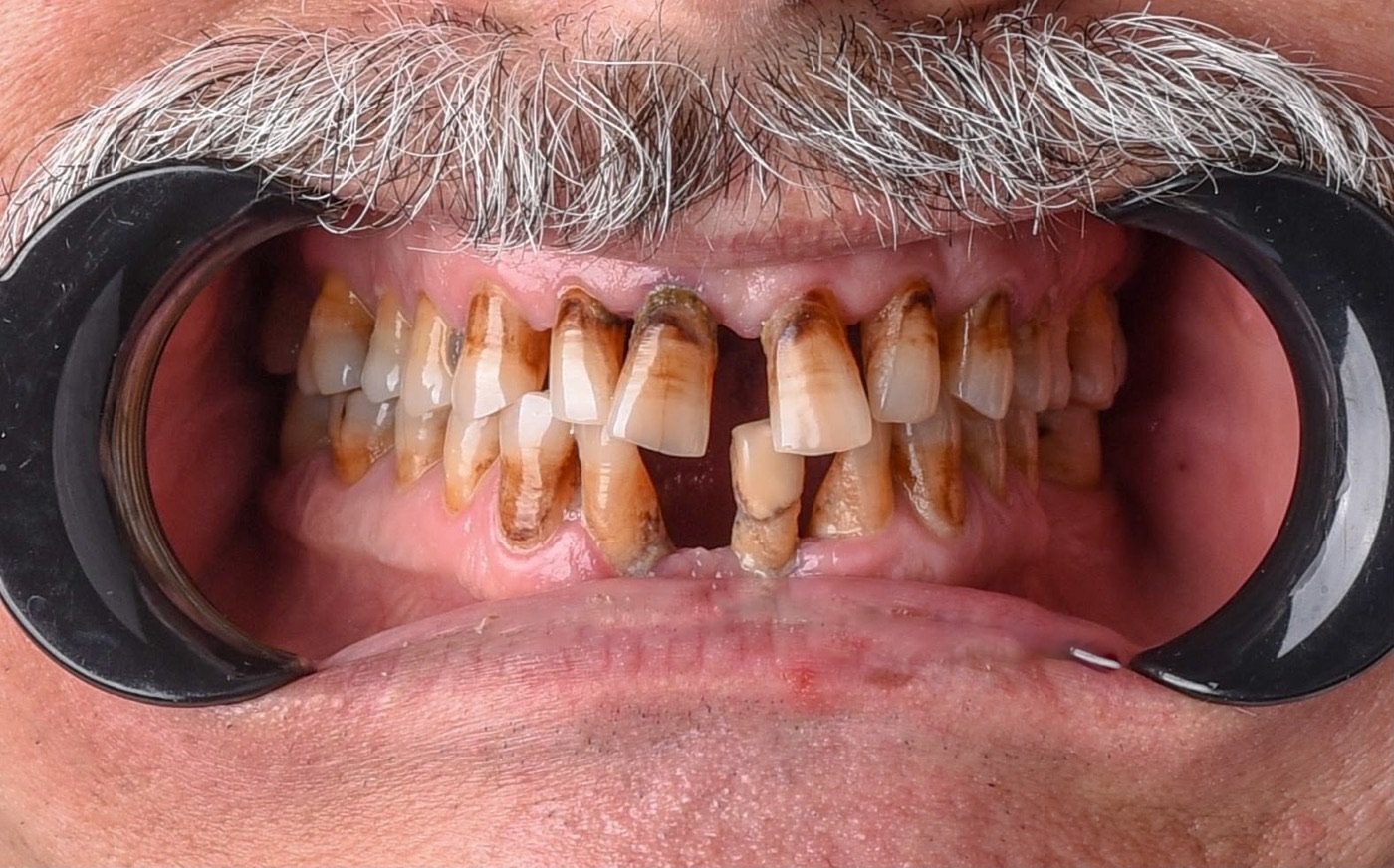Before treatment: heavily stained and worn teeth with exposed root surfaces, gaps between the front teeth and an irregular edge line