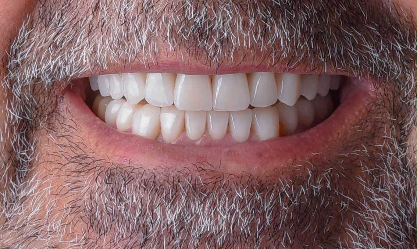After treatment: upper and lower teeth restored in lithium disilicate at the front and zirconia at the back, following an even edge line, photographed in the same natural smile