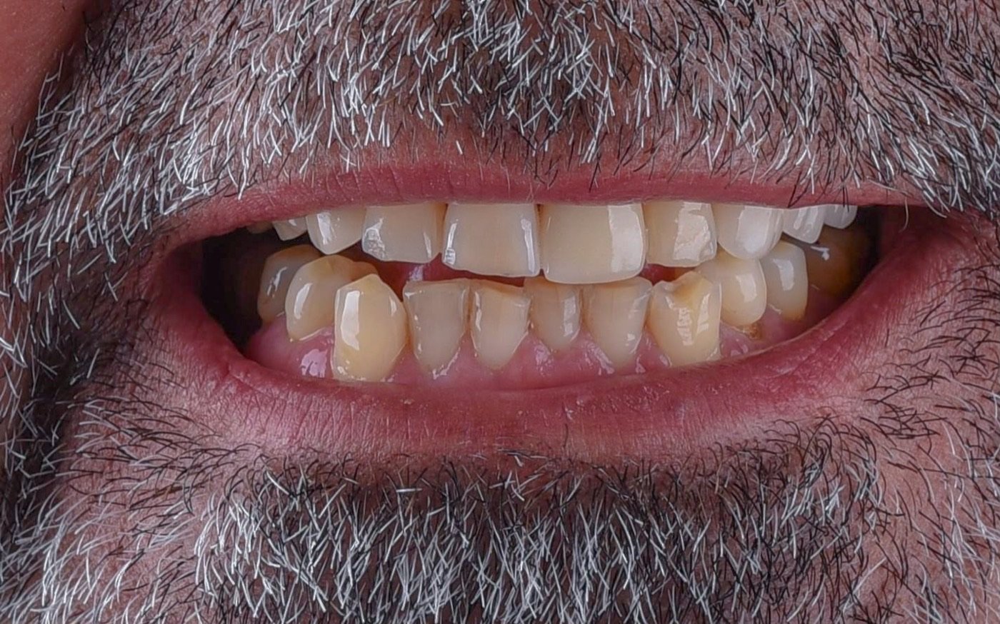 Before treatment: yellowed upper front teeth with chipped, uneven edges, and crowded lower front teeth with gum levels running at different heights, photographed in a natural smile