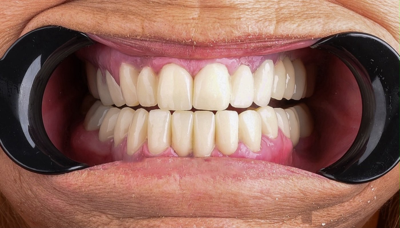 After treatment: both arches restored, with the back teeth replaced so the bite is carried at the back again and the front teeth rebuilt to the restored height