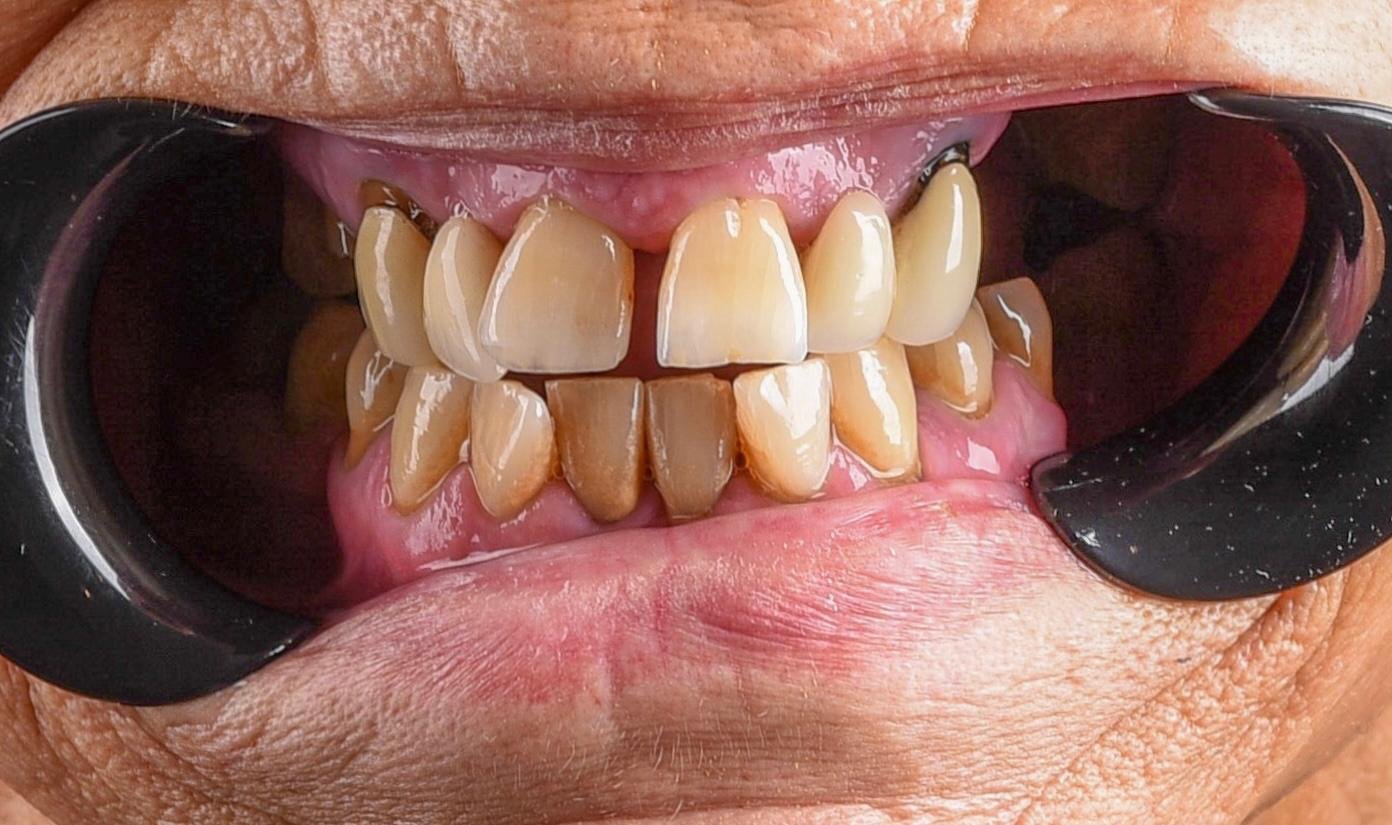 Before treatment: worn, unevenly shortened upper and lower front teeth meeting almost edge to edge, with empty spaces where the back teeth should be