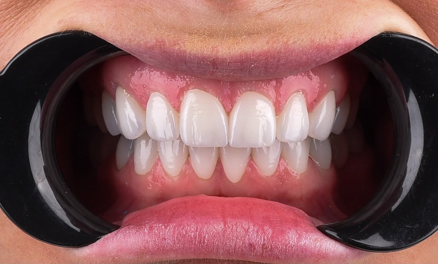 After treatment, the same retracted view: upper and lower teeth restored in one even shade, the gap between the central incisors closed and the edges following a single line