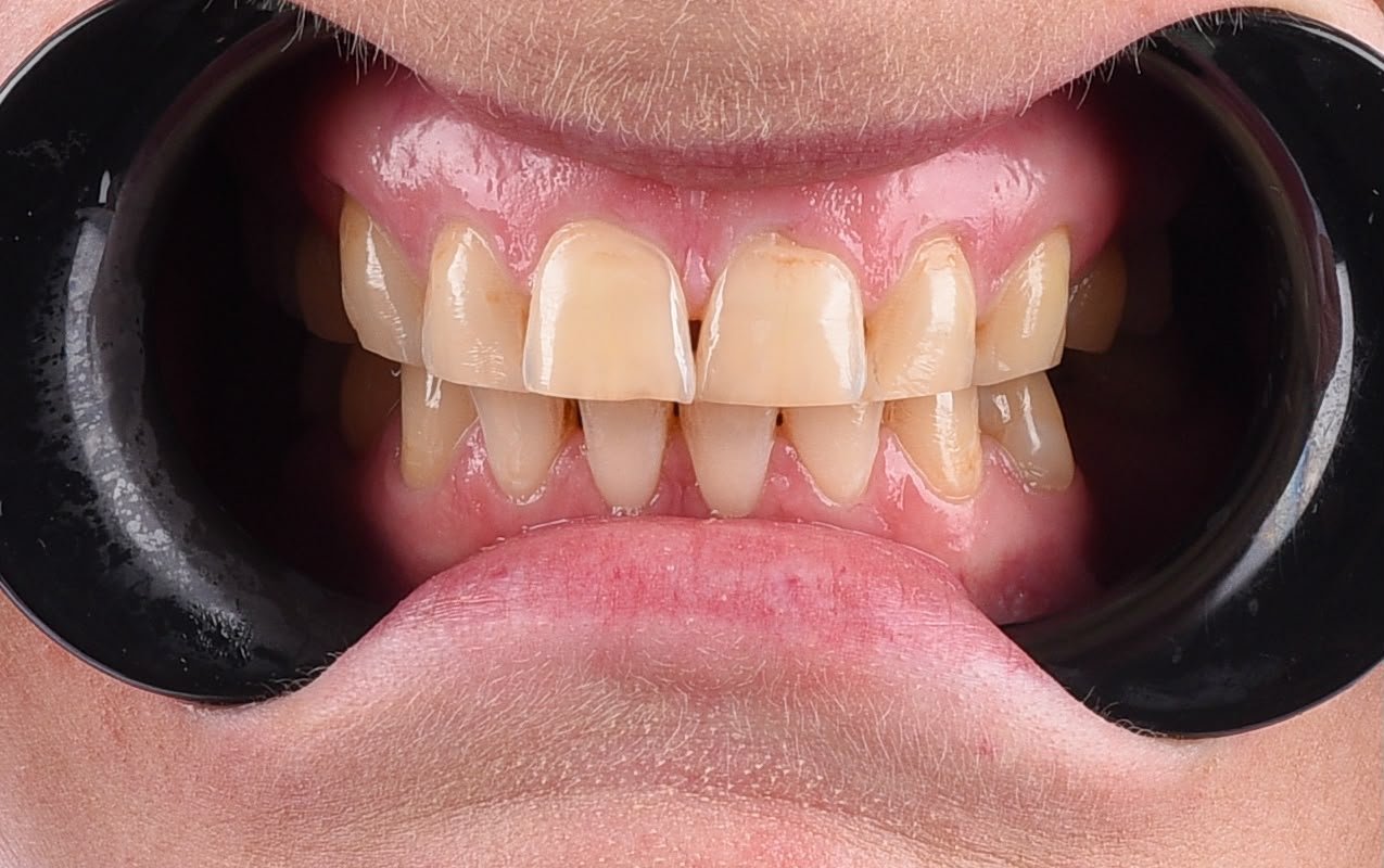 Before treatment, retracted view with the teeth together: upper and lower front teeth yellowed and stained brown along the gum line, a small gap between the upper central incisors and worn, uneven edges