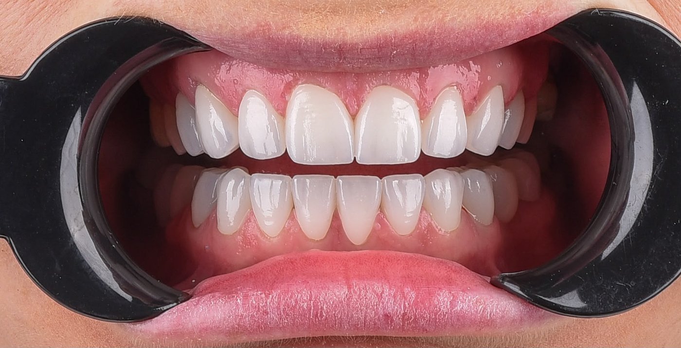 After treatment, the same view: upper and lower front teeth rebuilt to an even length and shape in one shade