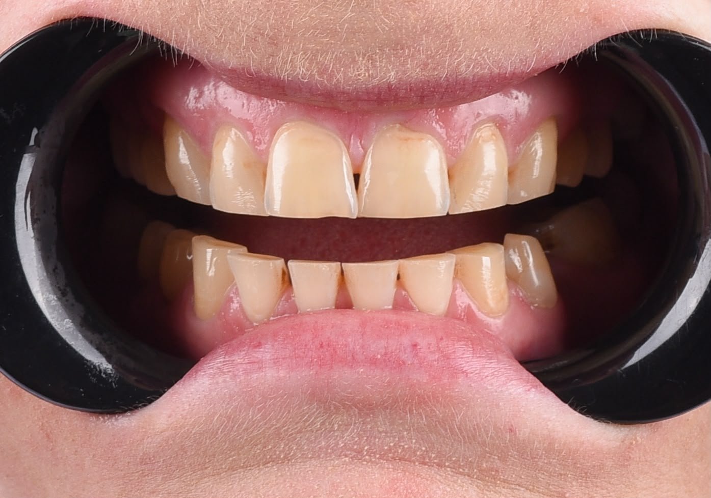 Before treatment, retracted view with the teeth slightly apart: worn, flattened lower front teeth with gaps between them and yellowed upper teeth