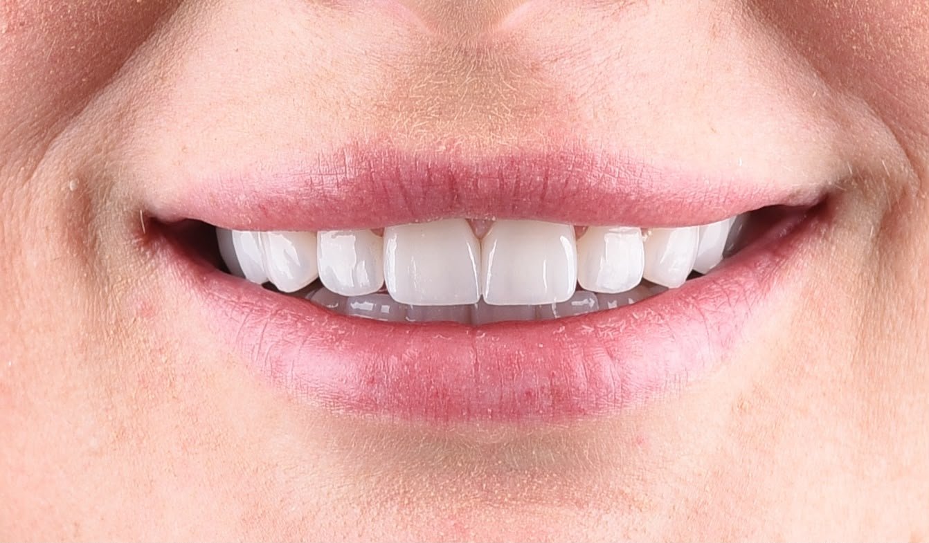 After treatment, natural smile: upper teeth in one even, light shade with edges following the curve of the lower lip