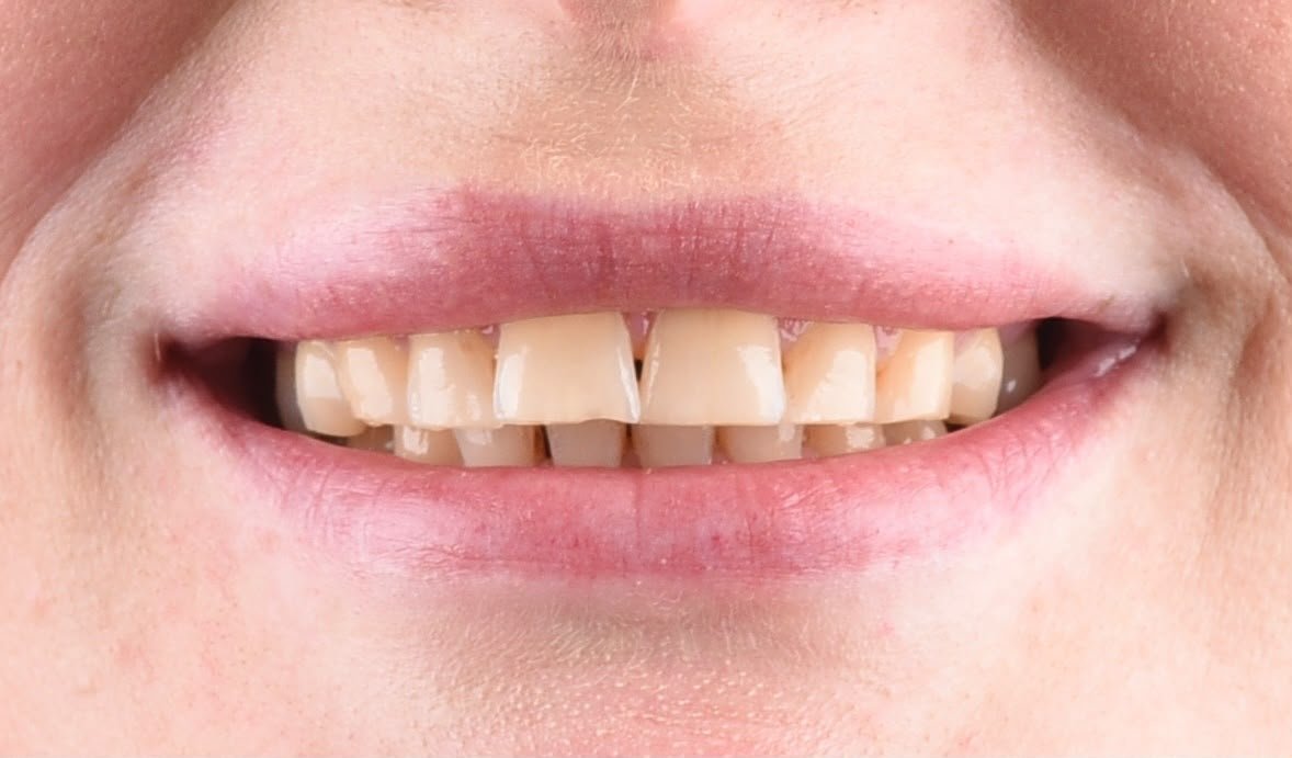 Before treatment, natural smile: yellowed upper teeth with uneven, worn edges